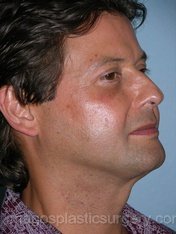 After liposuction male patient right 3/4 view case 4304