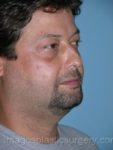 Before liposuction male patient right 3/4 view case 4304