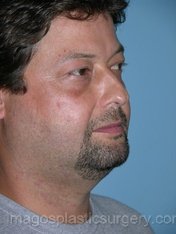 Before liposuction male patient right 3/4 view case 4304