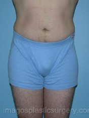 After liposuction male patient front view case 4309