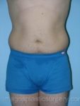 Before liposuction male patient front view case 4309
