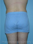 AFter liposuction male patient back view case 4309