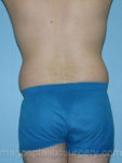 Before liposuction male patient back view case 4309