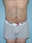 After liposuction male patient view view case 4314