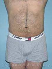 After liposuction male patient view view case 4314