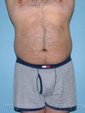 Before liposuction male patient front view case 4314
