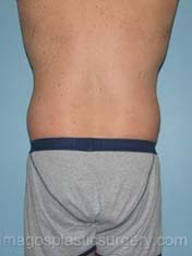 Before liposuction male patient right back view case 4314