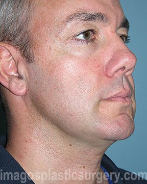 After liposuction male patient right 3/4 view case 4319