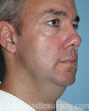 Before liposuction male patient right 3/4 view case 4319