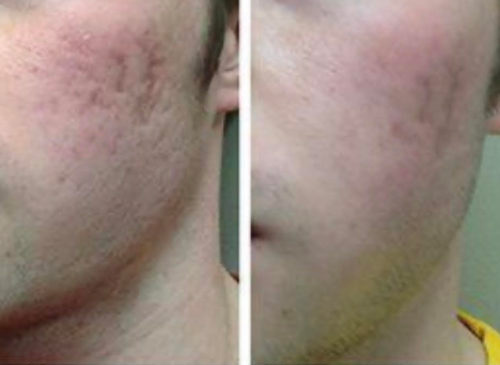 Before and after microneedling male patient cheek