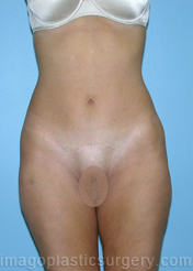 after front view mini tummy tuck of female patient 2937