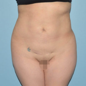 before front view mini tummy tuck of female patient 2942
