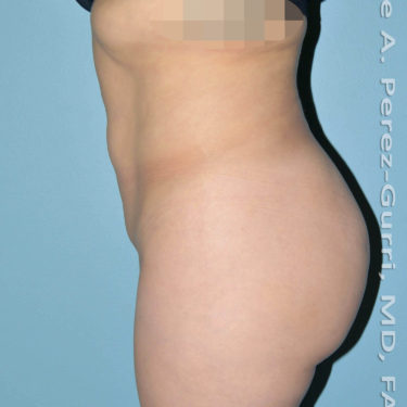 before left side view mini tummy tuck of female patient 2942