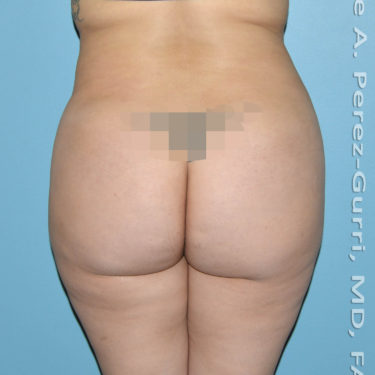 before back view mini tummy tuck of female patient 2942