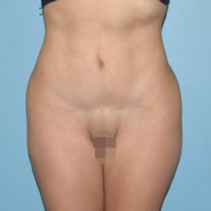 after front view mini tummy tuck of female patient 2942