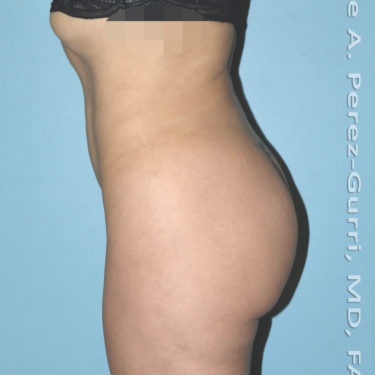 before left side view mini tummy tuck of female patient 2942