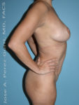 After Mommy makeover after right side case 4811