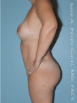 After Mommy makeover after left side case 4819