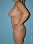 After Mommy makeover after left side case 4824