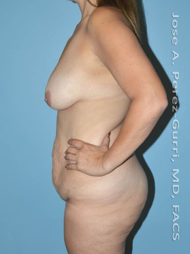 Before mommy makeover left side case 4829