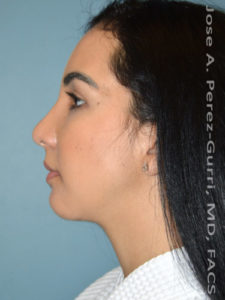 After rhinoplasty female patient left side view case 5230