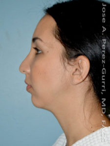 Before rhinoplasty female patient left side view case 5230