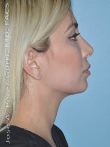 After rhinoplasty female patient right side view case 5237