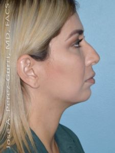 Before rhinoplasty female patient right side view case 5237