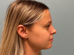 After rhinoplasty female patient right side view case 5242