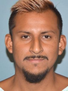 Before rhinoplasty male patient front view case 5252