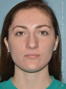 Before rhinoplasty female patient front view case 5257