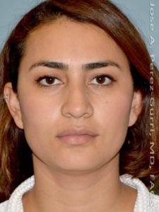 Before rhinoplasty female patient front view case 5262