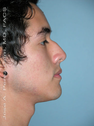 before right side view rhinoplasty of male patient 2577