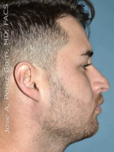 before right side view rhinoplasty of male patient 2581