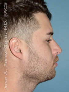 after right side view rhinoplasty of male patient 2581