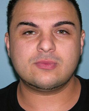 before front view rhinoplasty of male patient 2584