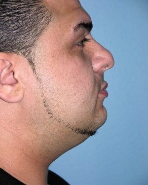 before right side view rhinoplasty of male patient 2584