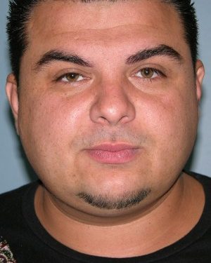 after front view rhinoplasty of male patient 2584