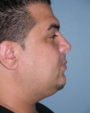 after right side view rhinoplasty of male patient 2584