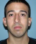 before front view rhinoplasty of male patient 2590