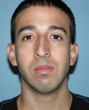 before front view rhinoplasty of male patient 2590