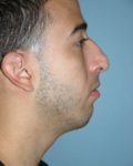 before right side view rhinoplasty of male patient 2590