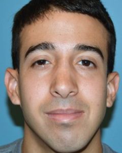 after front view rhinoplasty of male patient 2590
