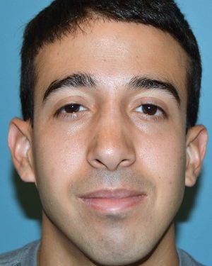 after front view rhinoplasty of male patient 2590