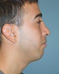after right side view rhinoplasty of male patient 2590