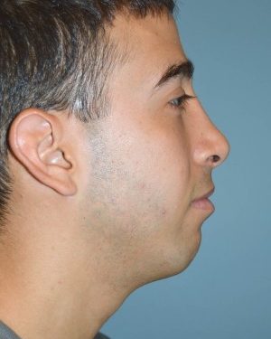 after right side view rhinoplasty of male patient 2590