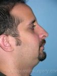 before right side view rhinoplasty of male patient 2595