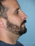 after right side view rhinoplasty of male patient 2595