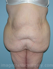 before front view surgery after major weight loss of female patient 2965