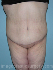 after front view surgery after major weight loss of female patient 2965